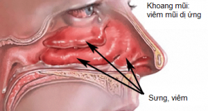 Bệnh viêm mũi dị ứng và cách điều trị